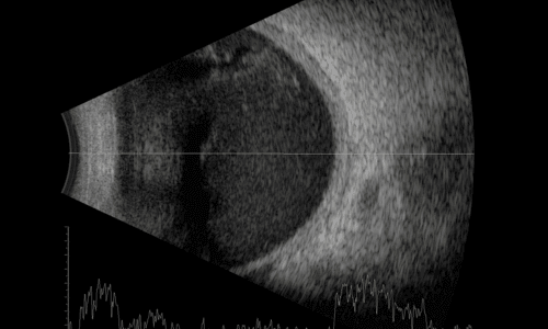 Ecografia Oftálmica A+B 
