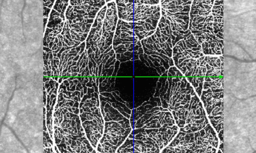 OCT-A (ANGIO-OCT) – Angiografia por tomografia de coerência óptica